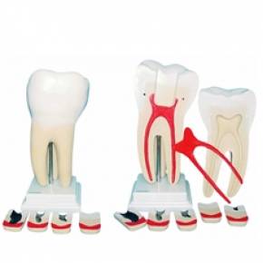 Dente Molar Ampliado 8 Partes com Evolução da Cárie